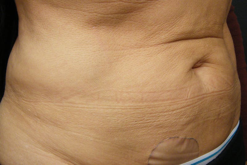 Body by Thermage Before & After Gallery - Patient 187469 - Image 3