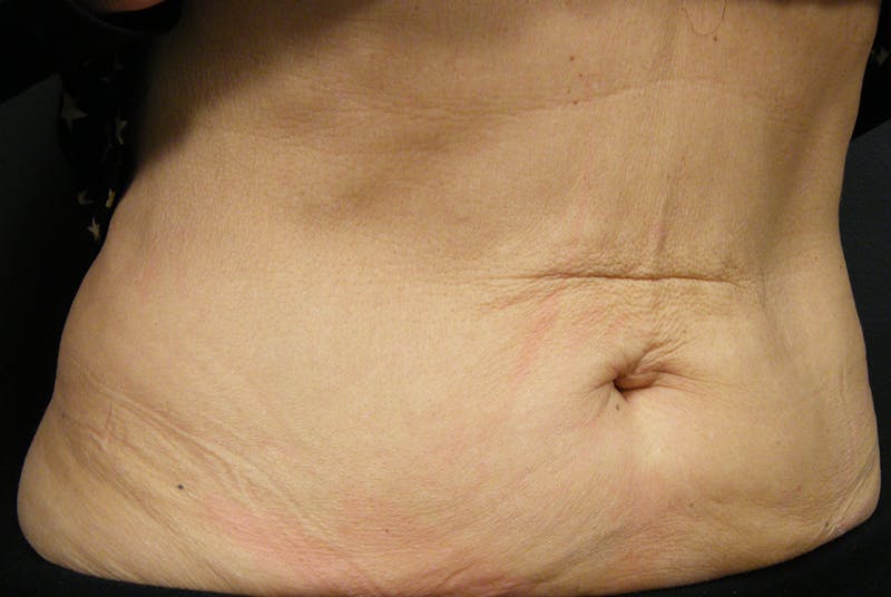 Body by Thermage Before & After Gallery - Patient 187469 - Image 4