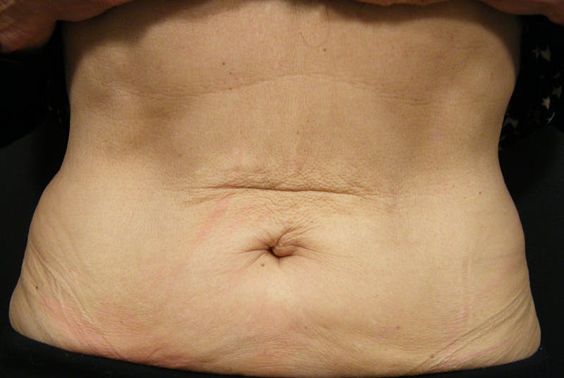 Body by Thermage Before & After Gallery - Patient 187469 - Image 2