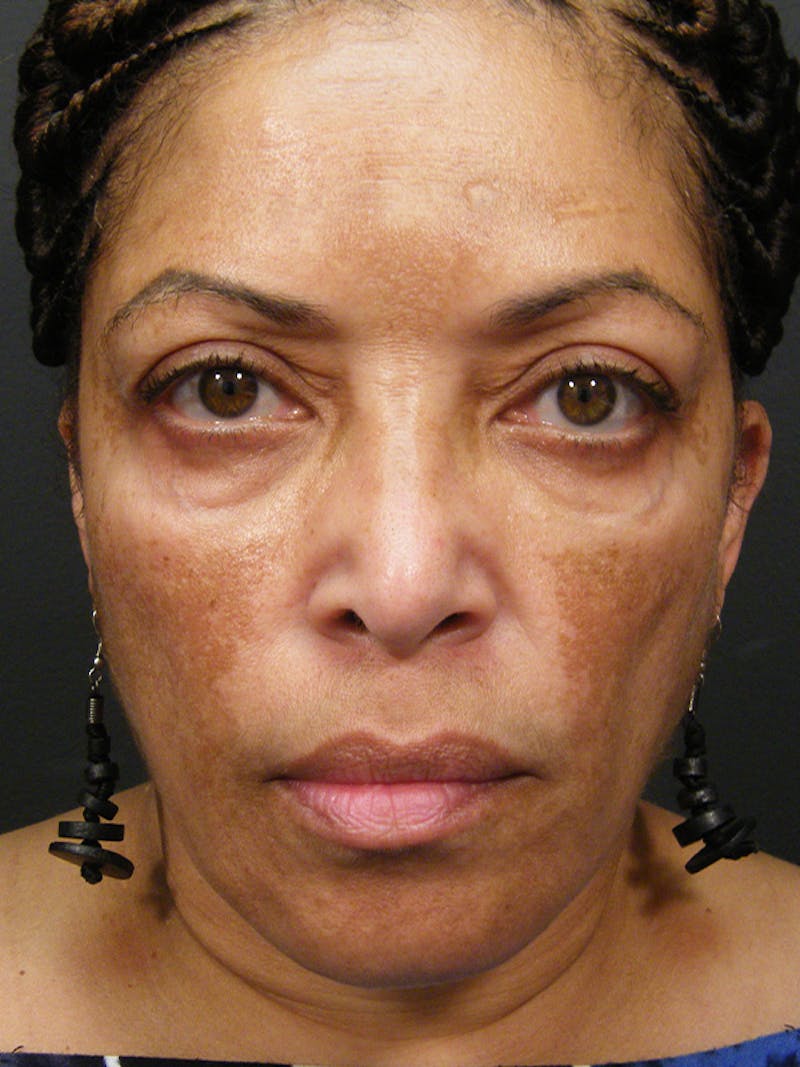 Medical Skin Care Before & After Gallery - Patient 409919 - Image 1