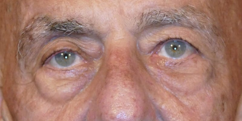 Cosmetic Surgeries Before & After Gallery - Patient 688461 - Image 1