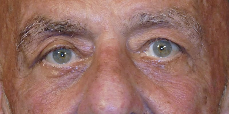 Cosmetic Surgeries Before & After Gallery - Patient 688461 - Image 2