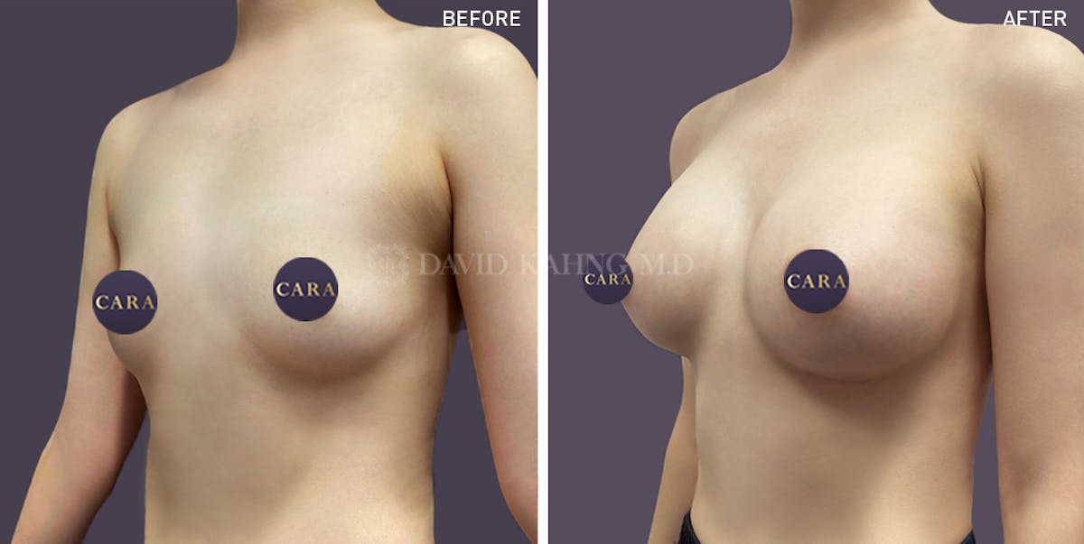 Breast Augmentation Before & After Gallery - Patient 127803 - Image 2