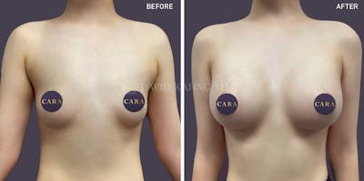 Breast Augmentation Before & After Gallery - Patient 127803 - Image 1