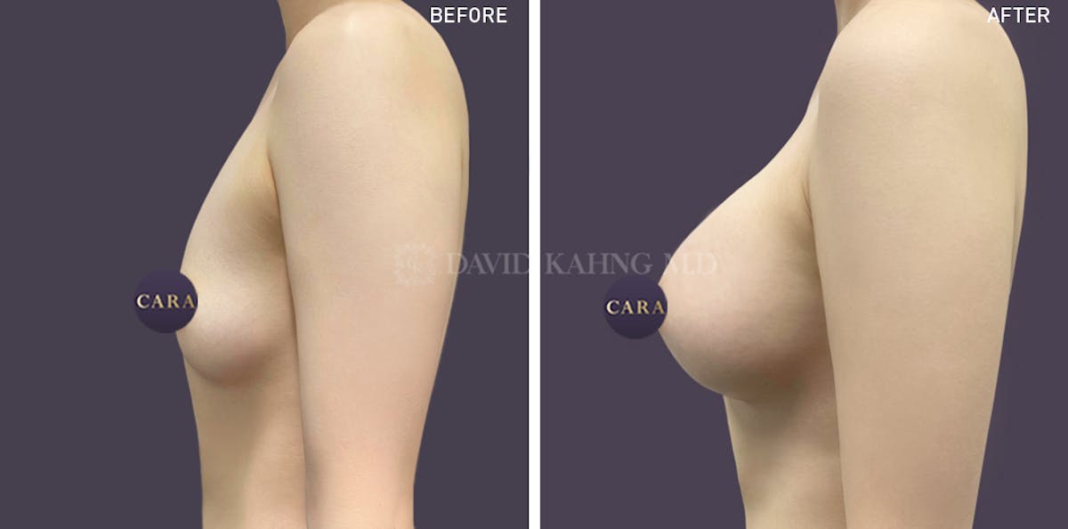 Breast Augmentation Before & After Gallery - Patient 201621 - Image 2
