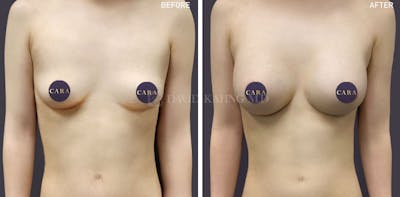 Breast Augmentation Before & After Gallery - Patient 201621 - Image 1