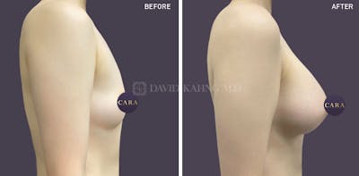 Asian Breast Augmentation Before & After Gallery - Patient 393819 - Image 1