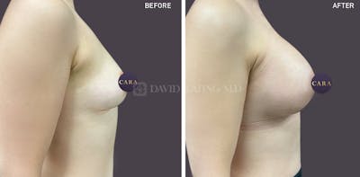 Asian Breast Augmentation Before & After Gallery - Patient 408921 - Image 1