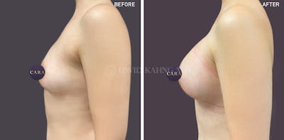 Asian Breast Augmentation Before & After Gallery - Patient 400534 - Image 1