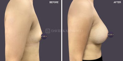 Asian Breast Augmentation Before & After Gallery - Patient 356435 - Image 1