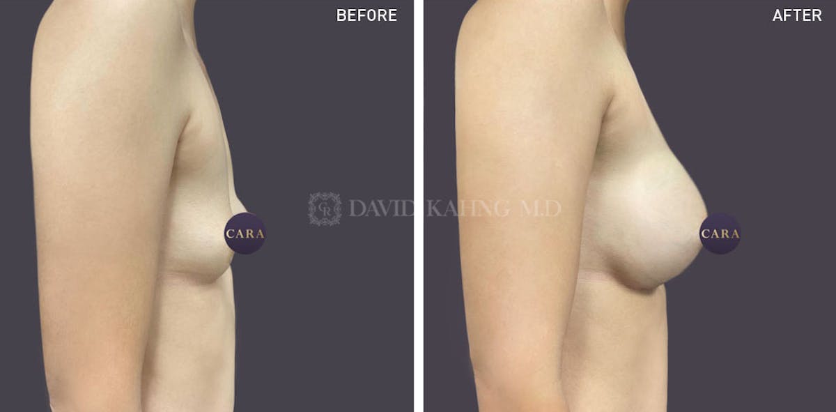 Breast Augmentation Before & After Gallery - Patient 387447 - Image 1
