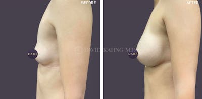 Asian Breast Augmentation Before & After Gallery - Patient 169984 - Image 1