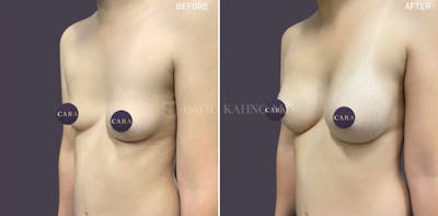 Asian Breast Augmentation Before & After Gallery - Patient 305277 - Image 1