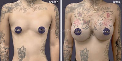 Breast Augmentation Before & After Gallery - Patient 843758 - Image 1