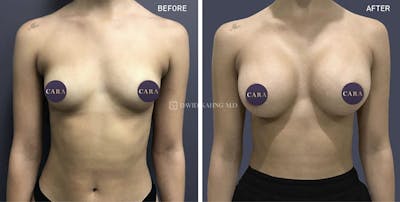 Breast Augmentation Before & After Gallery - Patient 627939 - Image 1