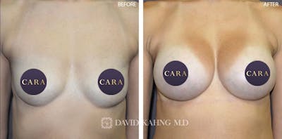 Breast Augmentation Before & After Gallery - Patient 579918 - Image 1