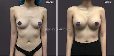 Breast Augmentation Before & After Gallery - Patient 568007 - Image 1