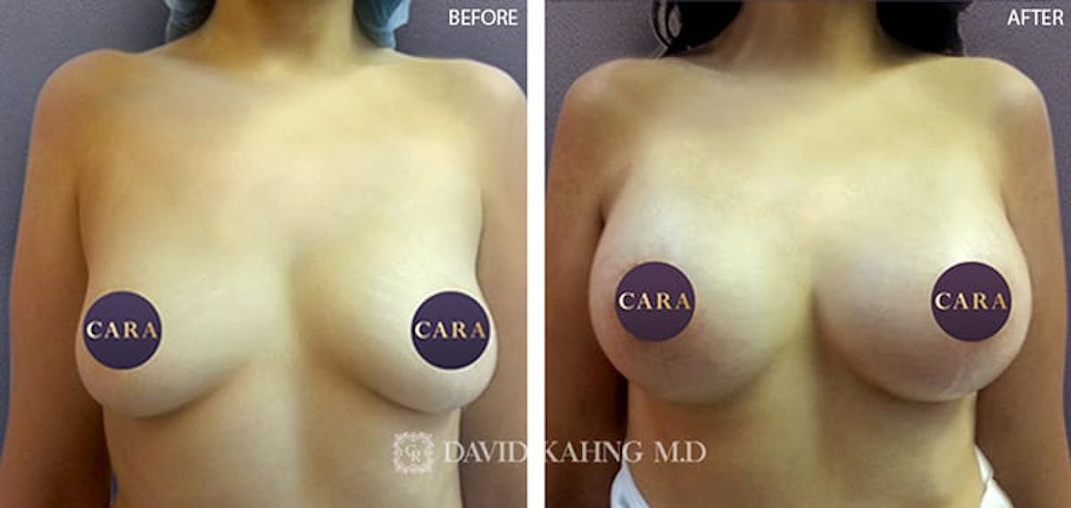 Breast Augmentation Before & After Gallery - Patient 280408 - Image 1