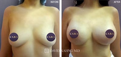 Breast Augmentation Before & After Gallery - Patient 280408 - Image 1