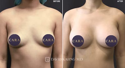Breast Augmentation Before & After Gallery - Patient 226674 - Image 1