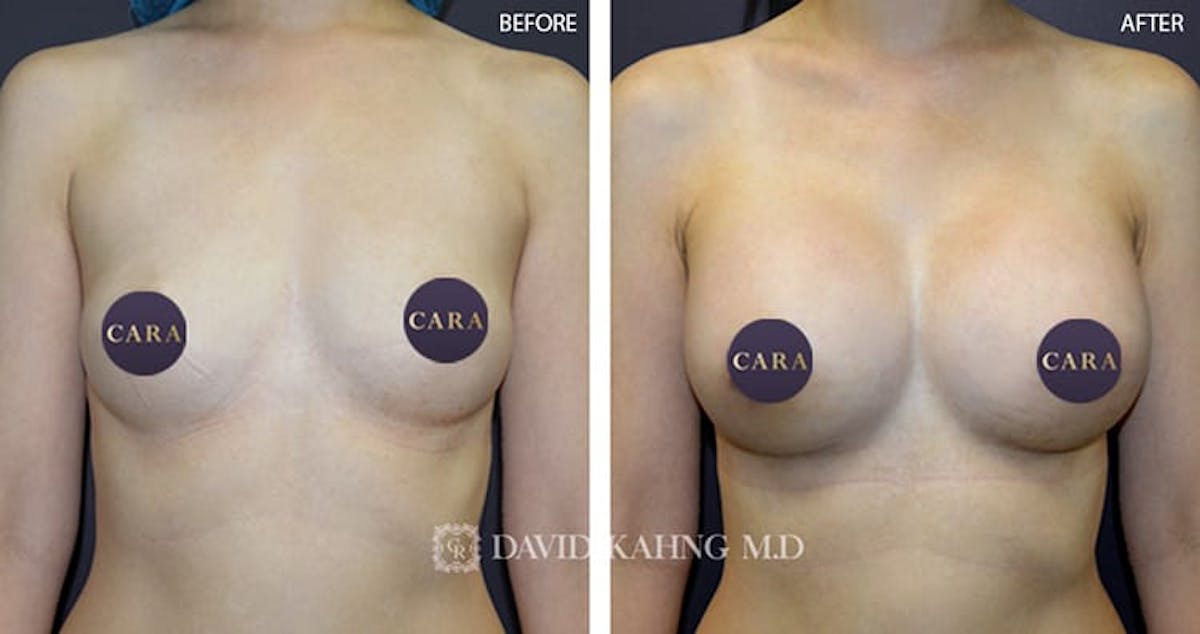 Breast Augmentation Before & After Gallery - Patient 859094 - Image 1