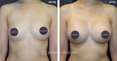 Breast Augmentation Before & After Gallery - Patient 859094 - Image 1
