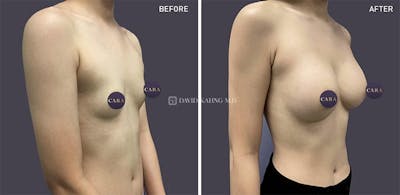Breast Augmentation Before & After Gallery - Patient 318731 - Image 1