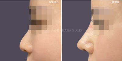 Rhinoplasty Before & After Gallery - Patient 325007 - Image 1