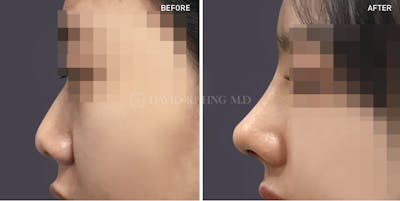 Rhinoplasty Before & After Gallery - Patient 205155 - Image 1