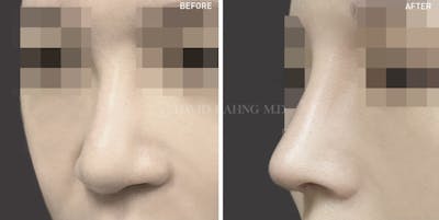 Rhinoplasty Before & After Gallery - Patient 178039 - Image 1