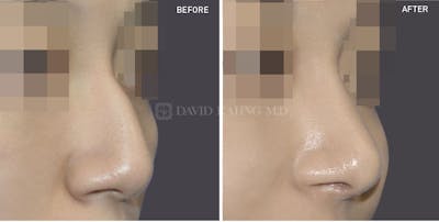 Rhinoplasty Before & After Gallery - Patient 532459 - Image 1