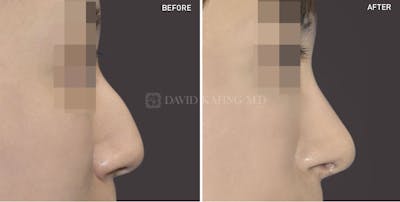 Rhinoplasty Before & After Gallery - Patient 154435 - Image 1