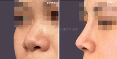 Rhinoplasty Before & After Gallery - Patient 248682 - Image 1