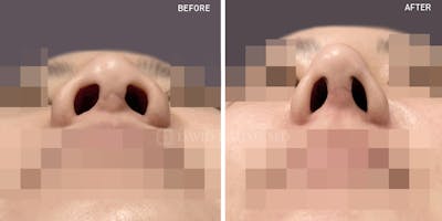 Rhinoplasty Before & After Gallery - Patient 125830 - Image 1