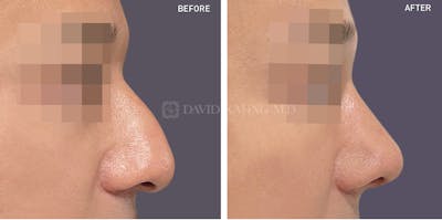 Rhinoplasty Before & After Gallery - Patient 221053 - Image 1