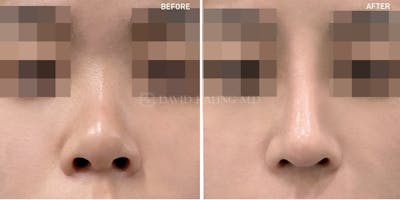 Rhinoplasty Before & After Gallery - Patient 371059 - Image 1