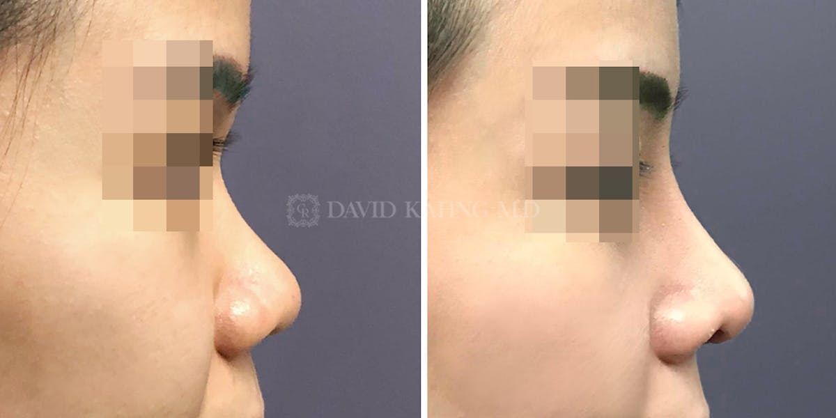 Rhinoplasty Before & After Gallery - Patient 226027 - Image 1