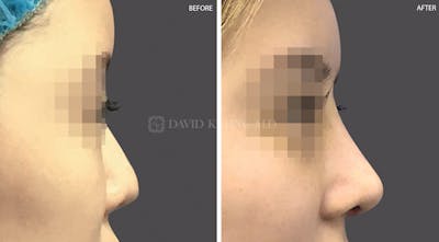 Rhinoplasty Before & After Gallery - Patient 675646 - Image 1