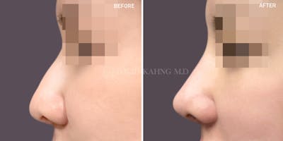 Rhinoplasty Before & After Gallery - Patient 257883 - Image 1