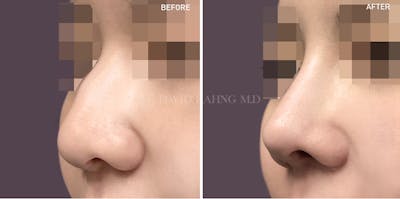 Rhinoplasty Before & After Gallery - Patient 186398 - Image 1