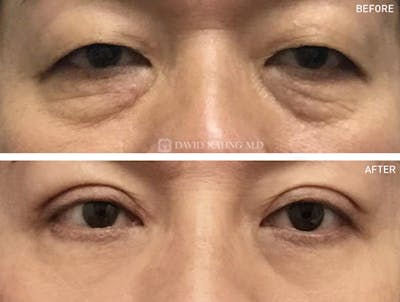 Lower Blepharoplasty Before & After Gallery - Patient 163297 - Image 1