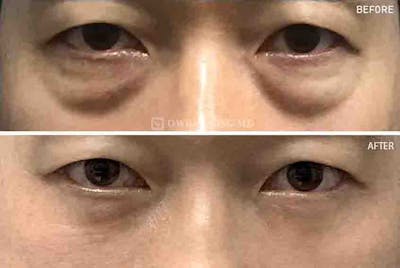 Lower Blepharoplasty Before & After Gallery - Patient 128932 - Image 1