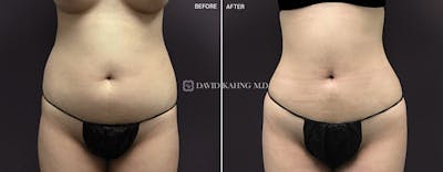 Liposuction Before & After Gallery - Patient 951518 - Image 1