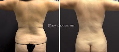 Liposuction Before & After Gallery - Patient 255725 - Image 1