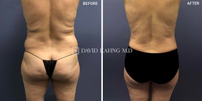 Liposuction Before & After Gallery - Patient 125527 - Image 1