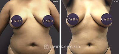 Liposuction Before & After Gallery - Patient 284195 - Image 1