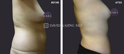 Liposuction Before & After Gallery - Patient 140523 - Image 1