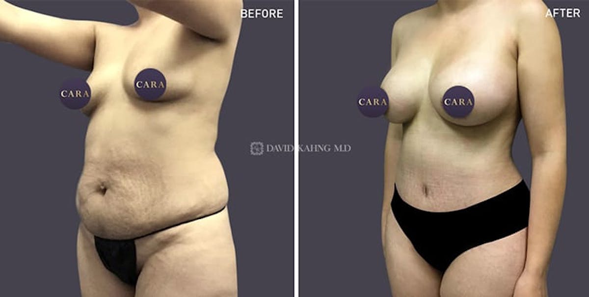 Tummy Tuck Before & After Gallery - Patient 327752 - Image 1