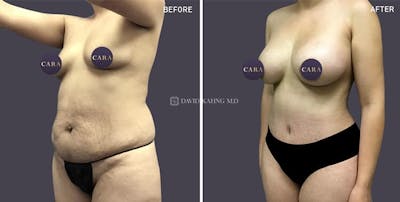 Tummy Tuck Before & After Gallery - Patient 327752 - Image 1
