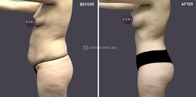 Tummy Tuck Before & After Gallery - Patient 399011 - Image 1
